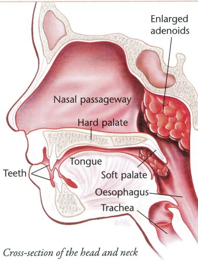 What Should you Expect during Post-Operative Care after Adenoidectomy?