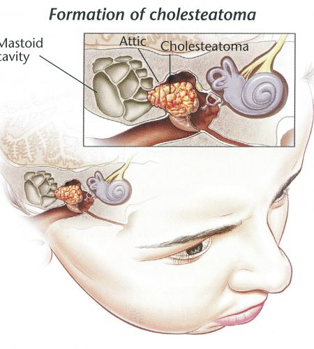 Mastoidectomy Or Tympanoplasty Dr Bridget Clancy Ent Surgeon