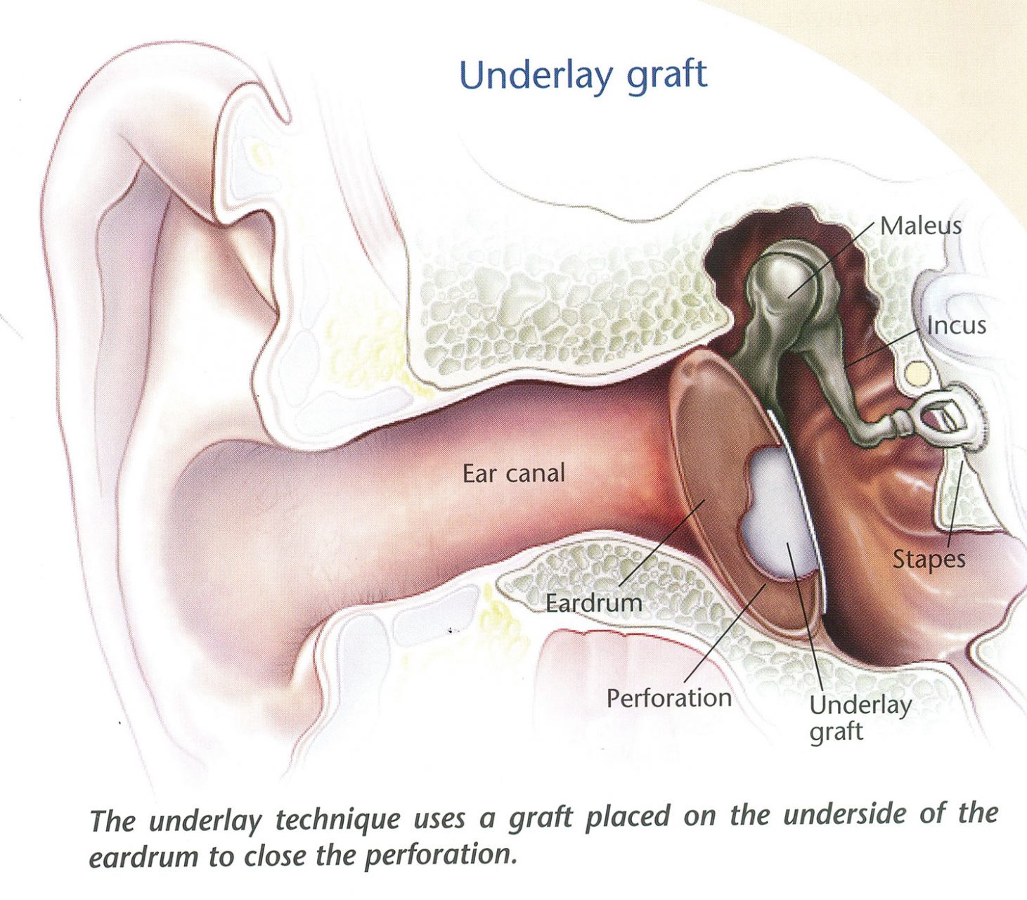 Myringoplasty (repairing a hole in the ear drum) Dr Bridget Clancy