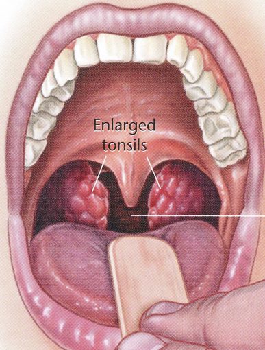 does a dog have tonsils