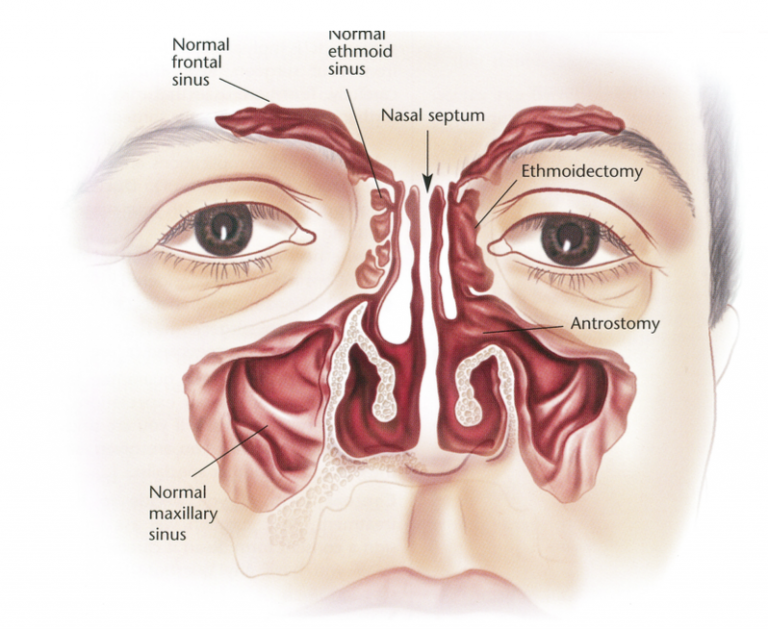 Sinus Surgery Dr Bridget Clancy Ent Surgeon 